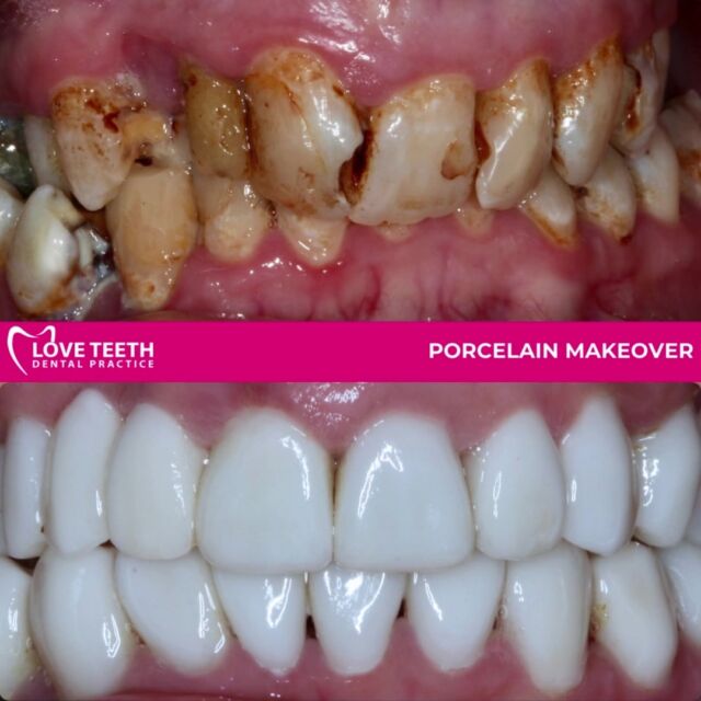 Crafting smiles with precision and artistry – another porcelain masterpiece unveiled! ✨ #DentistryMagic